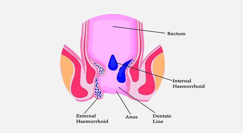 anatomical-picture-anal-hemorrhoids